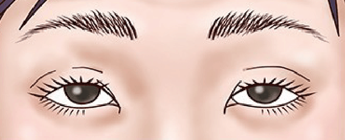 経結膜眼瞼下垂手術 前の目元イラスト